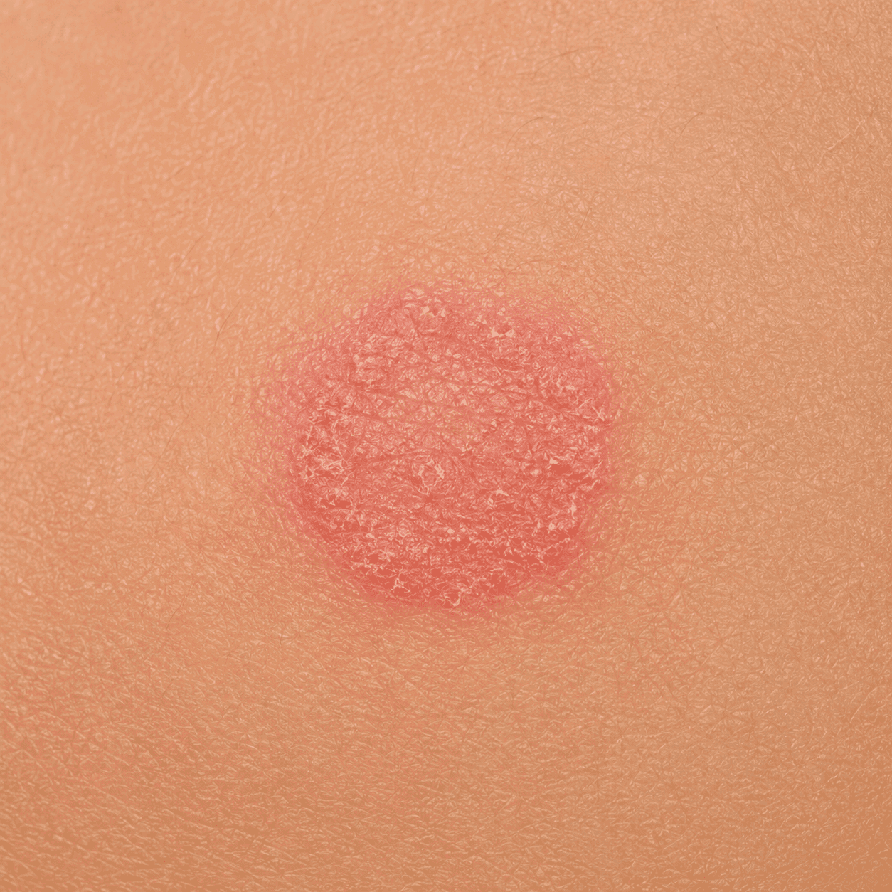 Annular skin lesion under analysis